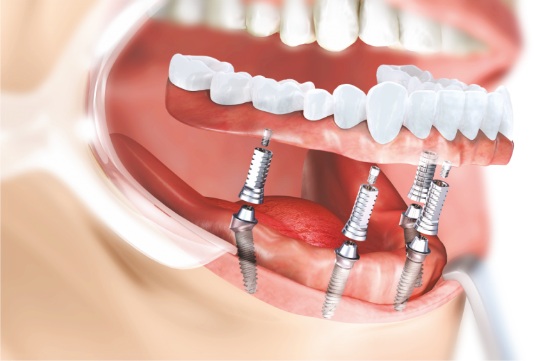 Cinci motive pentru a opta pentru un implant dentar