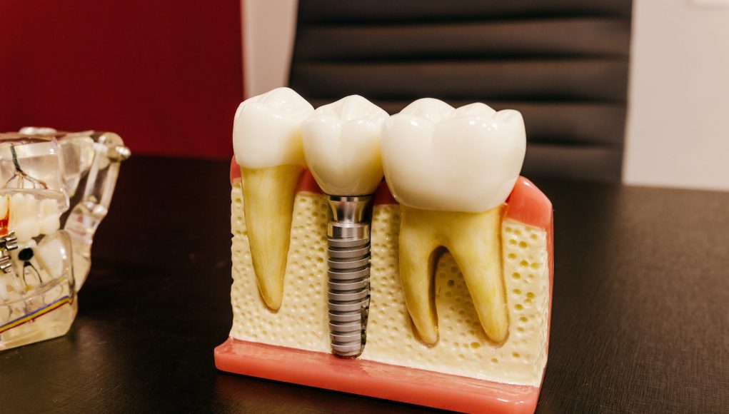 Implant dentar pret